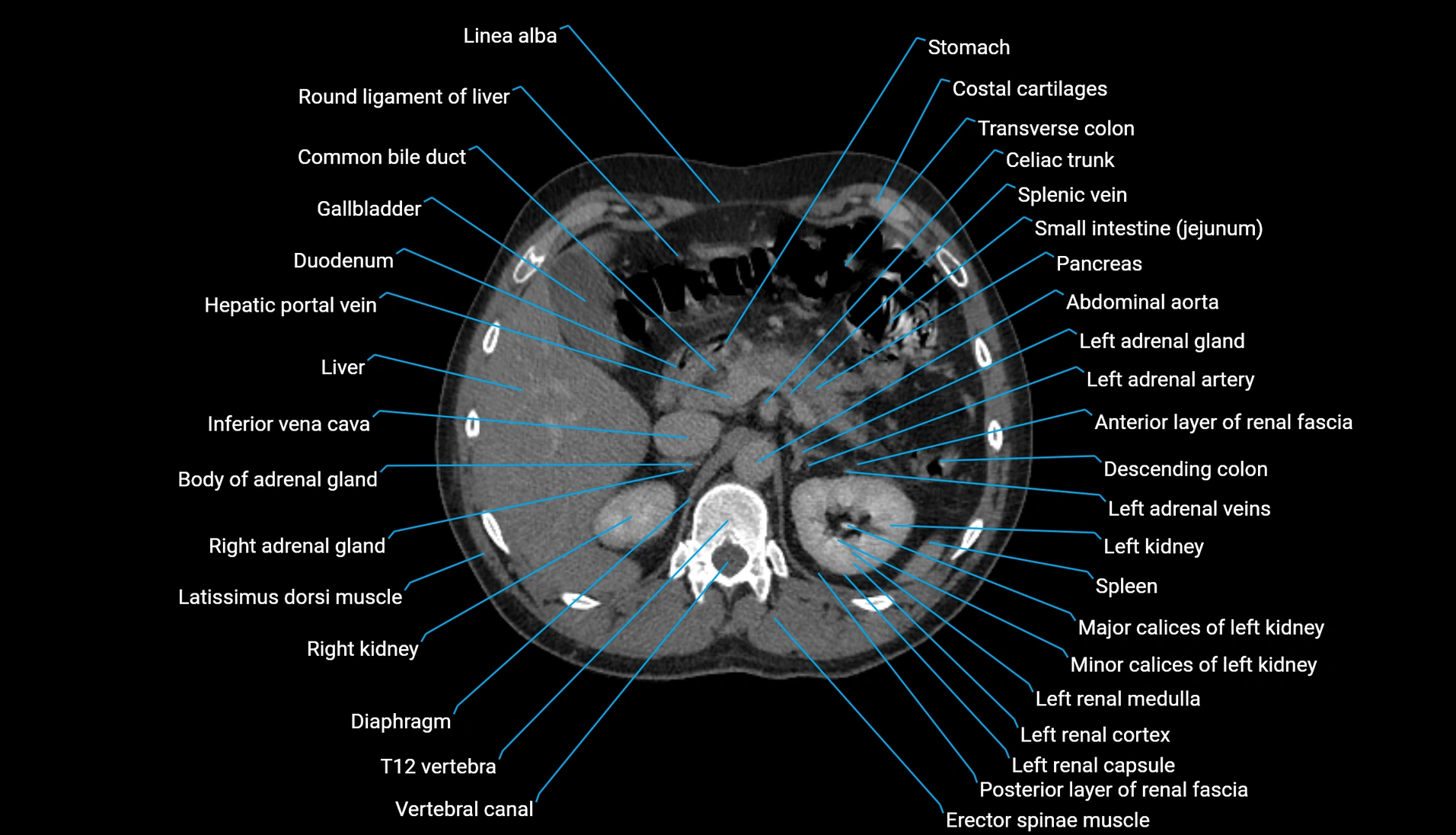 CT urogram axial cross sectional anatomy  labelled radiology image-00081.webp